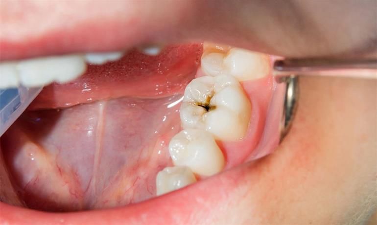 ترمیم پوسیدگی دندان و جلوگیری از پیشرفت پوسیدگی دندان